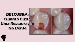 Descubra Se Você Realmente Precisa de uma Restauração no Dente e Qual o Preço Deste Tratamento