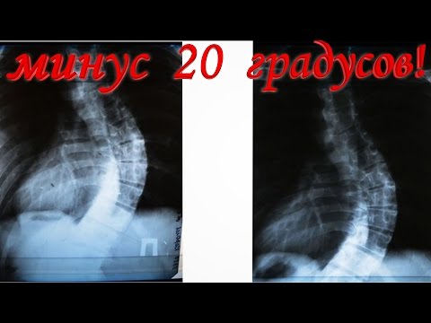 Сколиоз 2 степени в 5 лет Спортивные упражнение при сколиозе