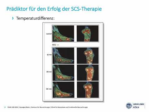 Dr. Georgios Matis - Neuromodulation - Rückenmarkstimulation & PAVK