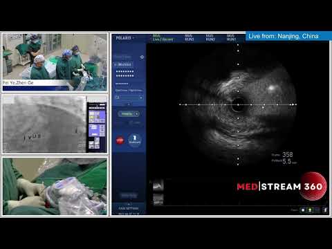 IVUS-Guided PCI Of LM Trifurcation Using IABP Support + RA