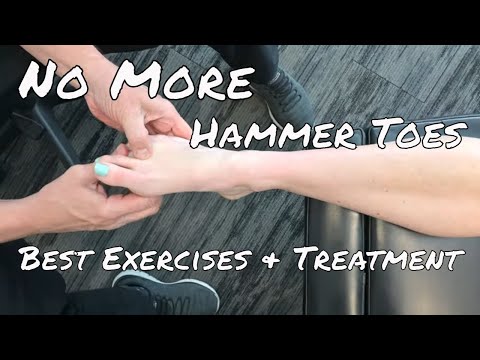 Hammer Toes: Over 90% Success Rate