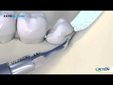 Piezotome Extraction protocol 3D