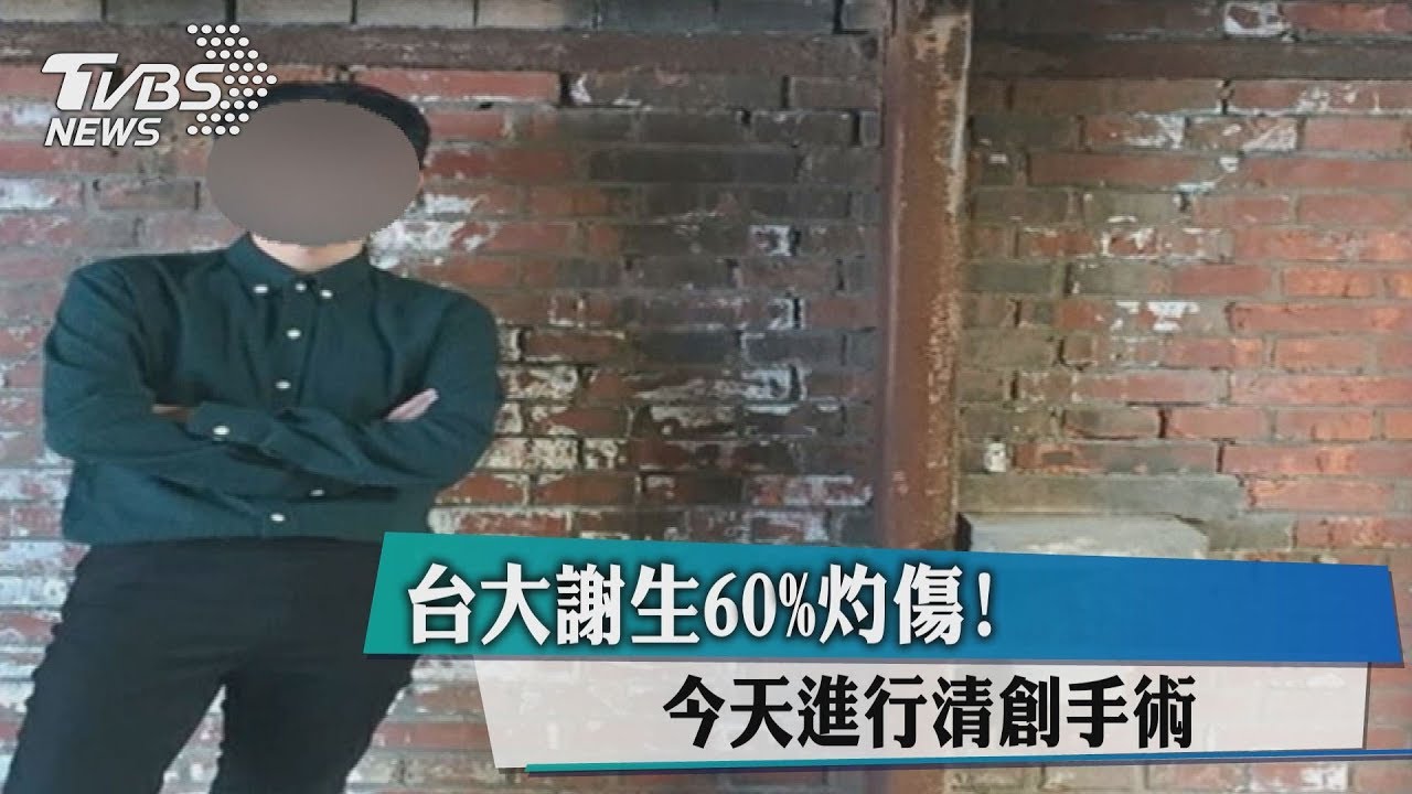 台大謝生60%灼傷! 預計今進行清創手術