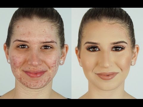 How To Correct & Conceal Acne ⎮Heidi Hamoud