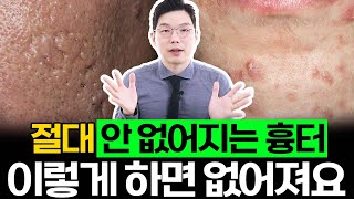 화강암 같은 여드름 흉터 치료는 뭐가 좋은지 시술별 효과 차이까지 총정리 해드릴게요 #여드름흉터