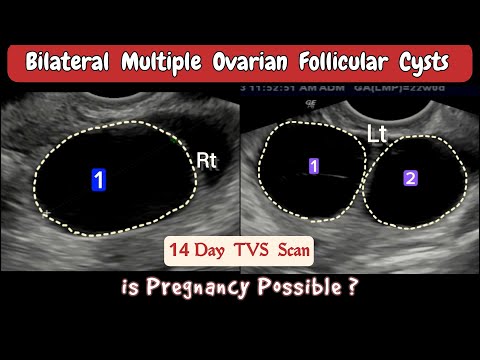 TVS Ultrasound - Bilateral multiple Ovarian Follicular Cysts