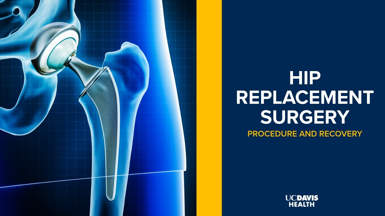 Thumbnail preview of  Hip Replacement Surgery Explained | UC Davis Health