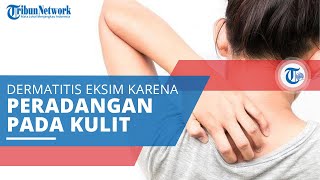 Dermatitis Atopik, Dermatitis Eksim yang Terjadi akibat Adanya Peradangan pada Kulit