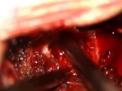 Recupero legamento del polso Giunti di diidrotestosterone