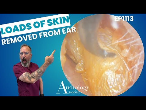 LOADS OF SKIN REMOVED FROM AN EAR CANAL - EP1113