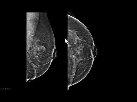 Achados mamográficos da queloide após mamoplastia