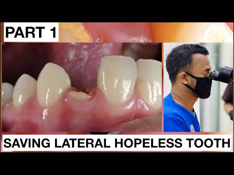 Step by Step Saving Lateral Hopeless Tooth. Part 1