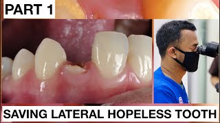 Step by Step Saving Lateral Hopeless Tooth #Part 1 | General Dentist Griya RR
