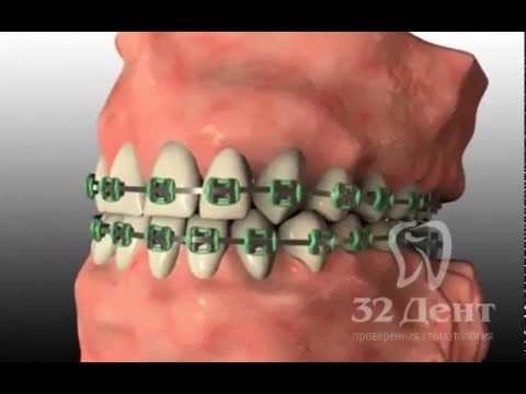 Ортодонтия. Как происходит процесс исправление прикуса
