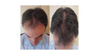 Τεχνική Αdvanced FUE - Δρ. Αναστάσιος Βεκρής (30sec)