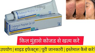 Clindac A Gel is an effective medicine for treating pimples and acne. Uses, Benefits, Side Effect...