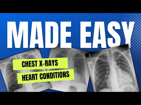 Heart Conditions: Chest X-rays Made Easy