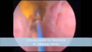 Cirugia laser de prostata, Dr. Sebastian Hervas - Dr. Sebastián Hervás