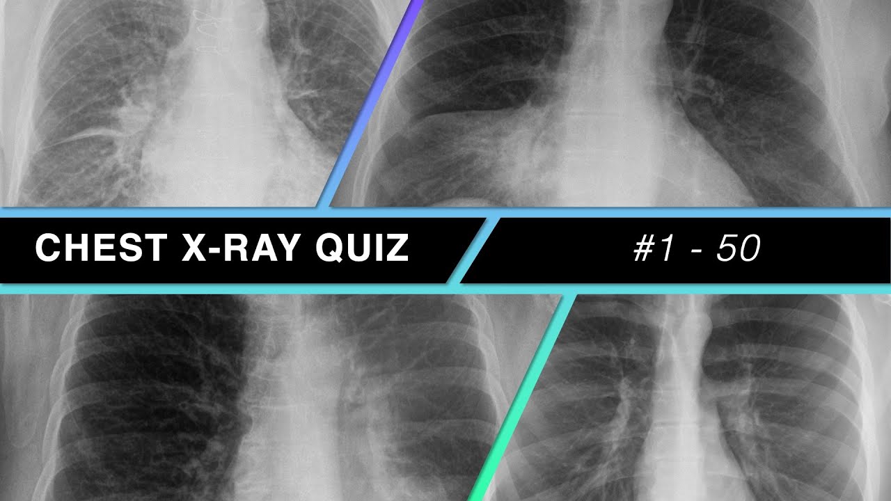 Chest X-ray Quiz #1 - 50