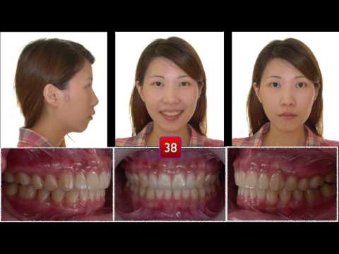 CC423. Correction of Skeletal Class ll Malocclusion