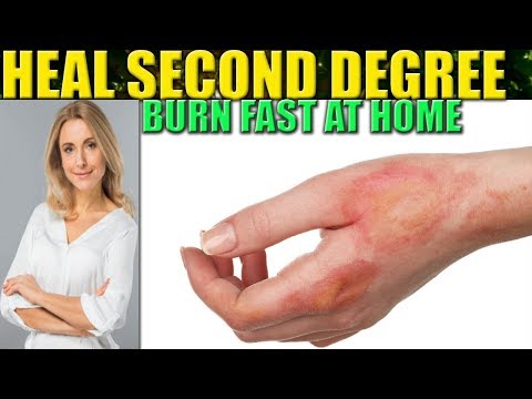 How To Heal A Burn Fast: 2nd Degree Burns Wound Care Home Remedies