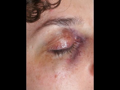 Comprare occhiali di massaggio da borse sotto occhi Locchio nero da trattamento di colpo si è gonfiato