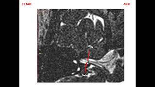 Download lagu MRI Inner EAR Normal Findings T2 mp3 Download lagu MRI Inner EAR Normal Findings T2 mp3