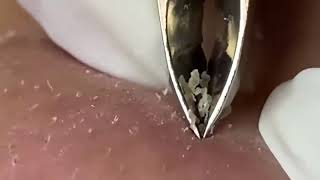 Download Lagu relax,Satisfying,nose blackheads,tweezers,acne treatment Thumbnail