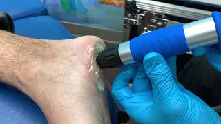 TRATAMIENTO DE ONDAS DE CHOQUE EXTRACORPOREA PARA EL DOLOR DEL TALÓN ♥️♥️♥️♥️