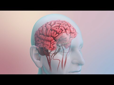 What Causes a Stroke?