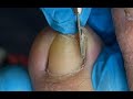 Huge ingrown toenail removal