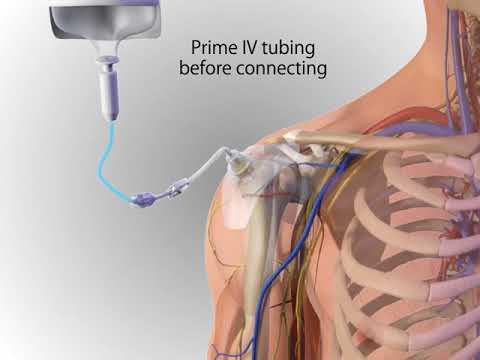 Arrow® EZ-IO® System - Proximal Humerus Site Identification/Insertion (Adult, Animation)