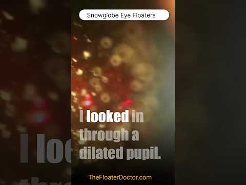 'Snowglobe' Eye Floaters: 100's of thousands of them