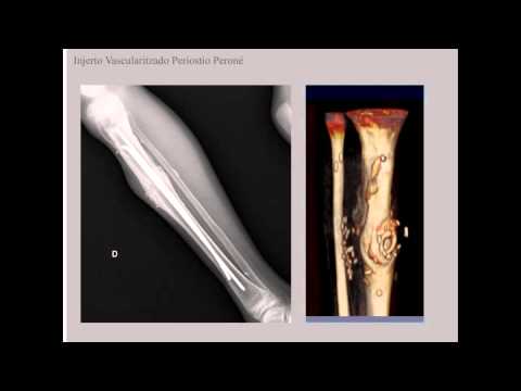 Alflutop ernia cervicale recensioni Mosca clinica nel trattamento del ginocchio
