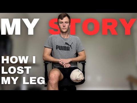 How I Lost My Leg - The Full Story