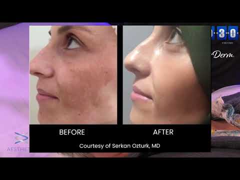 NOUVADerm™ Full Face Laser Skin Resurfacing Treatment Demonstration | Aesthetic Management Partners