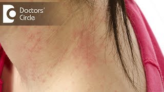 What does dry white itchy patch with redness indicate?-Dr. Rasya Dixit