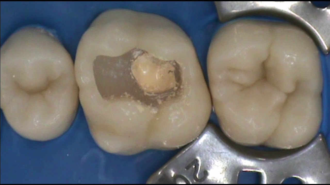 Capeamento Direto - Exposição pulpar