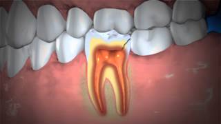 Treatment of Abscessed Teeth