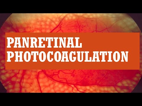 LASER TREATMENT FOR DIABETIC RETINOPATHY || PAN RETINAL PHOTOCOAGULATION ( PRP)