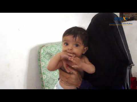 Malnutrition children U5yr &  PLW in Yemen