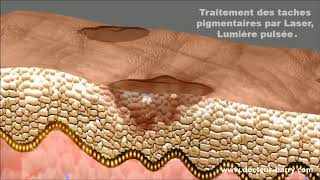 Traitement des tâches pigmentaires au laser - DR Barry