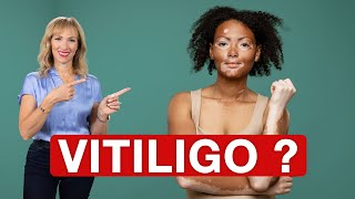 WHAT Causes VITILIGO | Dr. Janine