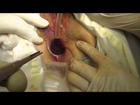 Papillary urothelial disease