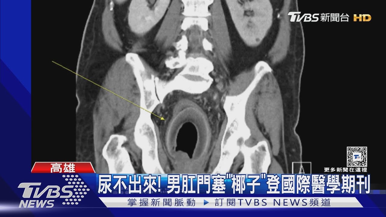 怎麼塞的？高雄男「椰子卡肛門」掛急診　醫開刀取出