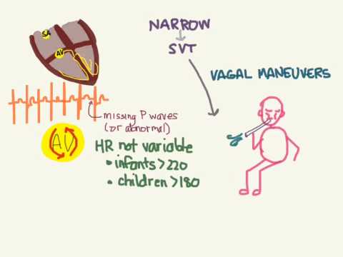 PALS 08: Tachycardias