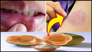 How to Get Rid Of Bruises in Just a Day – Bruise on Lips and Face for Natural Home Remedies