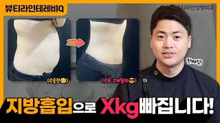 지방흡입하면 몸무게도 줄어들까? ㅣ지흡전후 몸무게 변화 / 다이어트 관리 꿀팁