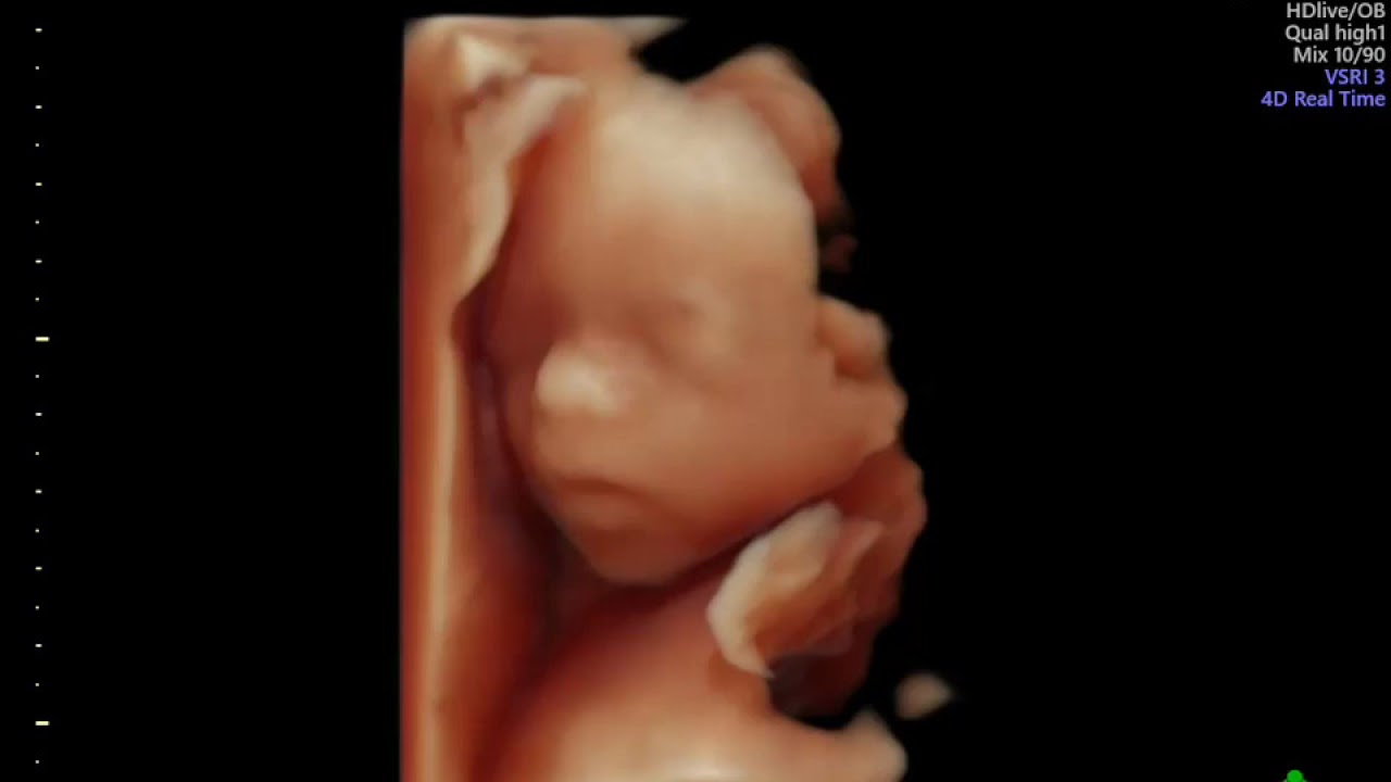 ULTRASSON 4D 23 SEMANAS