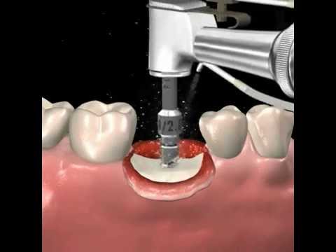 Step by step dental implant surgery